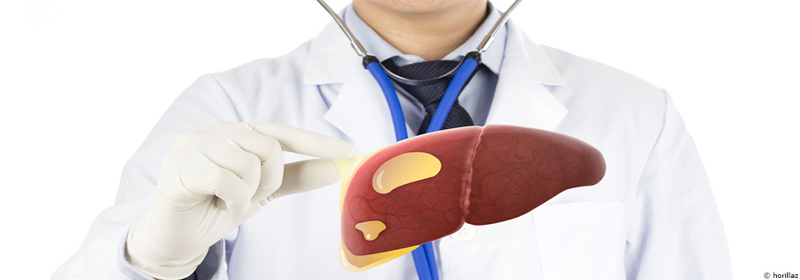NASH : la maladie du foie gras